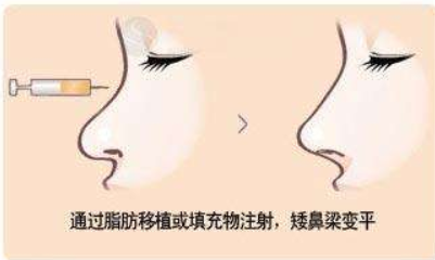 隆鼻材料你知多少?看看哪种适合你