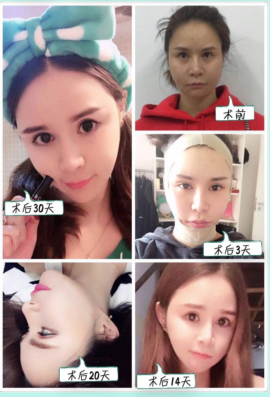 吸脂瘦脸一般都适合哪些人?