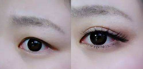 杭州割双眼皮多少钱合适?