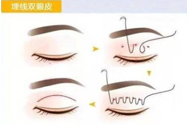 想要双眼皮?三个方法帮你甩掉肿眼泡