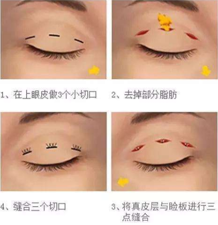 想要双眼皮?三个方法帮你甩掉肿眼泡