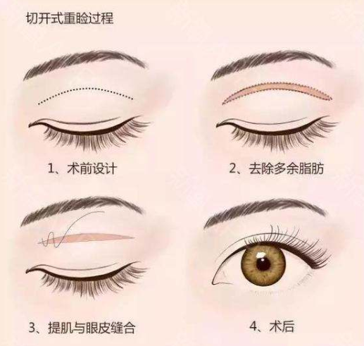 想要双眼皮?三个方法帮你甩掉肿眼泡