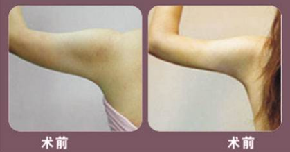 吸脂会让皮肤松弛吗?