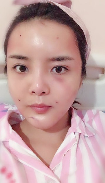 在成都驻颜做的自体脂肪填充全脸,好显年轻~