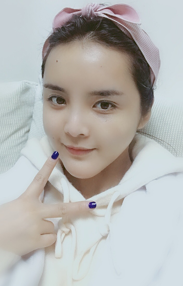 在成都驻颜做的自体脂肪填充全脸,好显年轻~