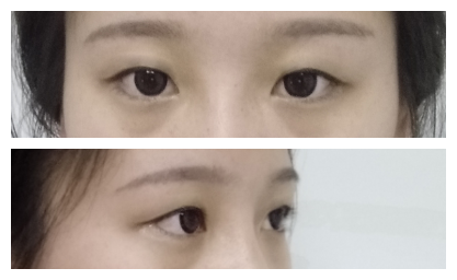 在成都美绽美做的双眼皮,恢复了很好看~