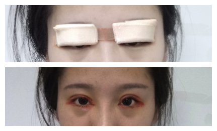 在成都美绽美做的双眼皮,恢复了很好看~