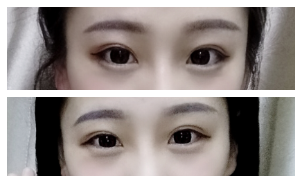 在成都美绽美做的双眼皮,恢复了很好看~