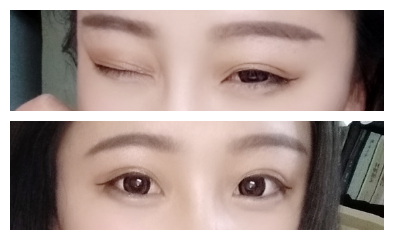 在成都美绽美做的双眼皮,恢复了很好看~