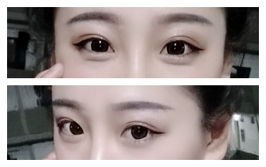在成都美绽美做的双眼皮,恢复了很好看~