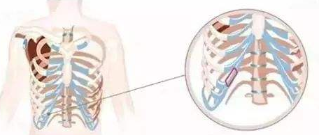 肋软骨隆鼻中的全肋和半肋有什么区别?