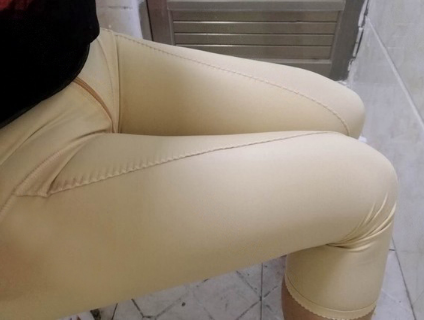 在深圳广和做了大腿吸脂,今天第28天了