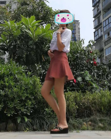 在深圳广和做了大腿吸脂,今天第28天了