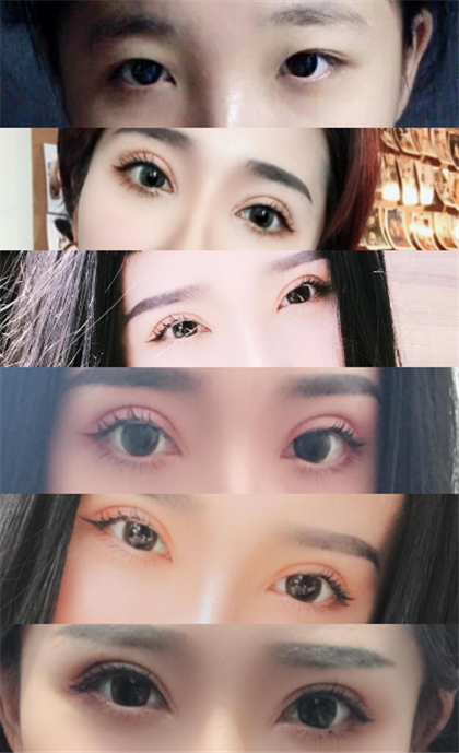 武汉华美的马行做的双眼皮,八个月了*果很好