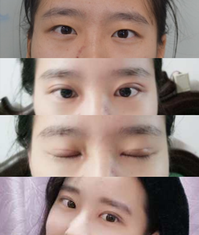 在温州星范做的全切双眼皮,已经35天了