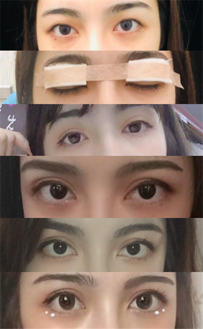 在深圳美加美做的双眼皮,已经恢复了