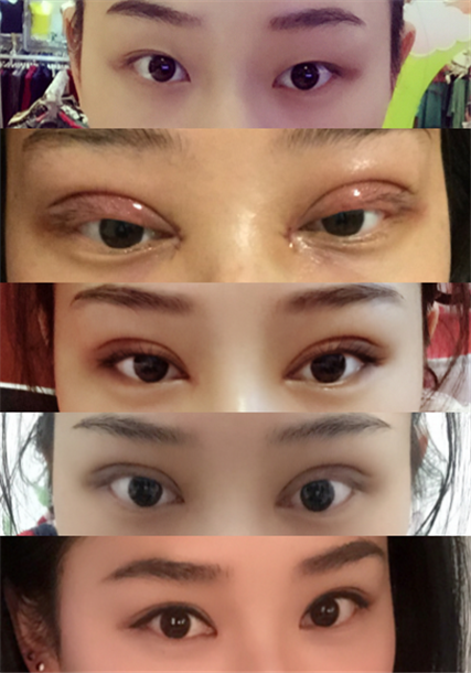 在江西广济做的全切双眼皮+开眼角,已经三个月