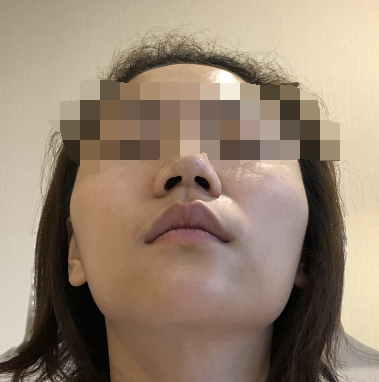 在杭州华山连天美做的磨骨,*果很好