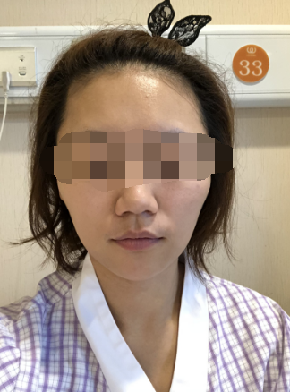 在杭州华山连天美做的磨骨,*果很好