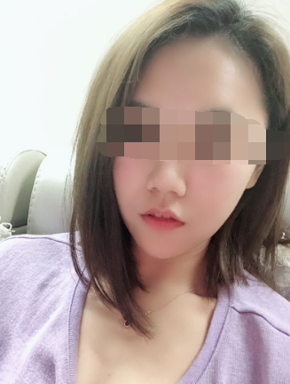 在杭州华山连天美做的磨骨,*果很好