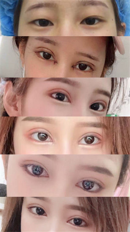 在郑州美眼做的双眼皮修复,已经三个月多了
