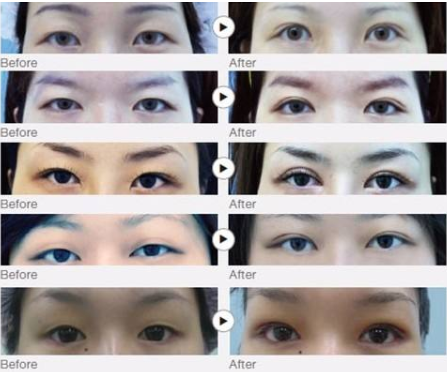 广州双眼皮医院医生测评(公立部分)