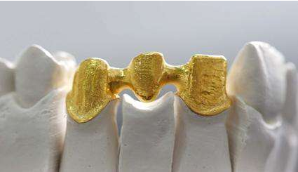 贵金属烤瓷牙 贵金属烤瓷牙