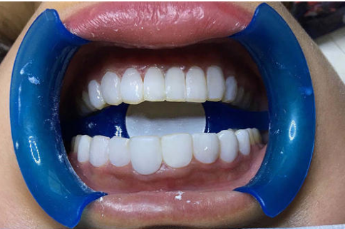 树脂贴面 树脂贴面