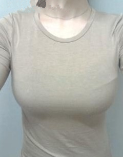 360cc,硅胶假体隆胸,不再是平胸女了!!