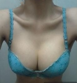 360cc,硅胶假体隆胸,不再是平胸女了!!