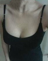 360cc,硅胶假体隆胸,不再是平胸女了!!