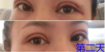 全切加开内眼角,恢复后整个气质up!