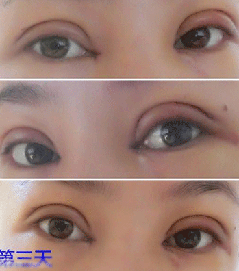 全切加开内眼角,恢复后整个气质up!