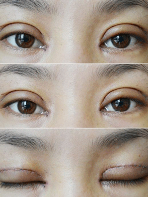 全切加开内眼角,恢复后整个气质up!