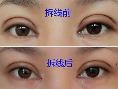 全切加开内眼角,恢复后整个气质up!