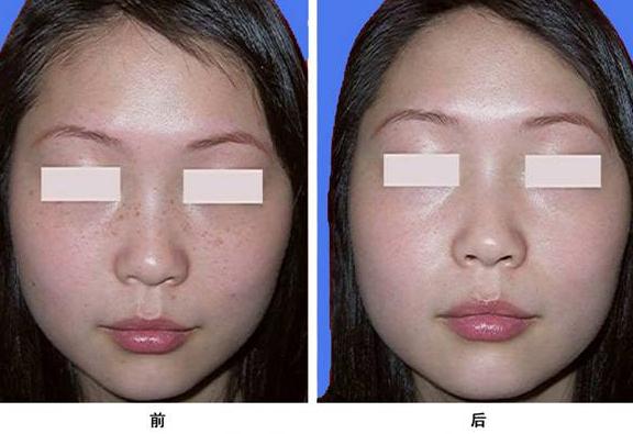 激光祛斑的价格多少?激光祛斑一次多少钱?