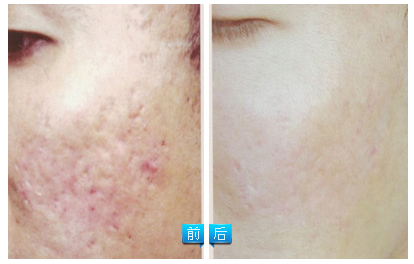 国内彩光嫩肤去痘印痘坑怎么样?