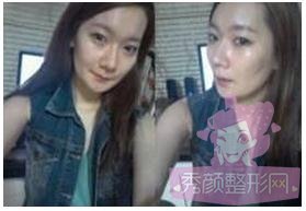 做了自体脂肪填充丰脸,很年轻有木有?