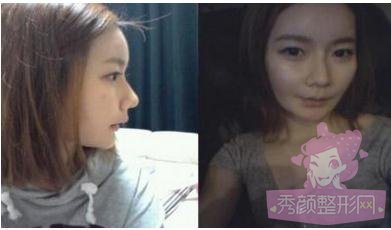 做了自体脂肪填充丰脸,很年轻有木有?