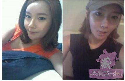 做了自体脂肪填充丰脸,很年轻有木有?