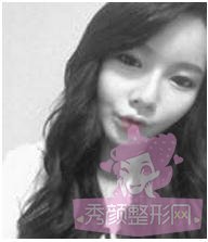 做了自体脂肪填充丰脸,很年轻有木有?