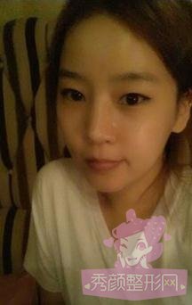 【隆鼻手术】和大家分享我的隆鼻经验