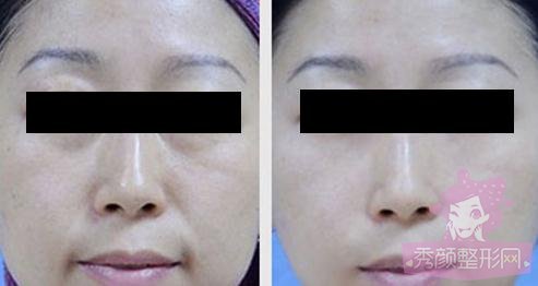 超声提拉除皱怎么样?果好吗?原理是什么?