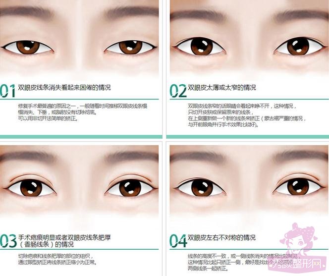 北京八大处靳小雷双眼皮修复怎么样?案例图?