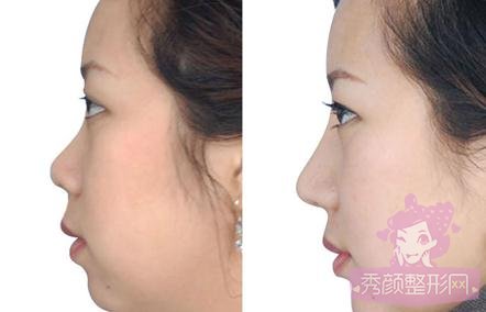 上海九院王涛隆鼻怎么样?价格是多少?