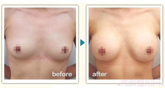 北京八大处栾杰内窥镜隆胸怎么样?有案例吗?