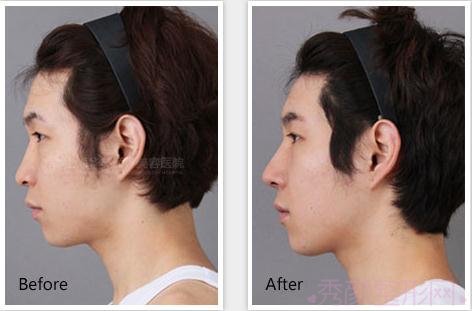 上海华美隆鼻哪个好?李庭勋、谢卫国还是李健