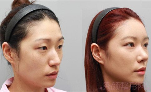 上海华美隆鼻哪个好?李庭勋、谢卫国还是李健