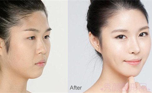 上海华美隆鼻哪个好?李庭勋、谢卫国还是李健