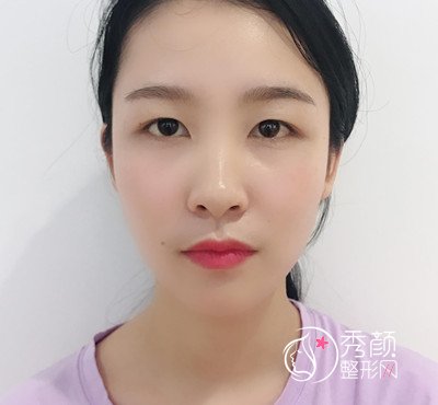 上海华美杨亚益割双眼皮开眼角恢复过程,7mm扇形真的很适合我!